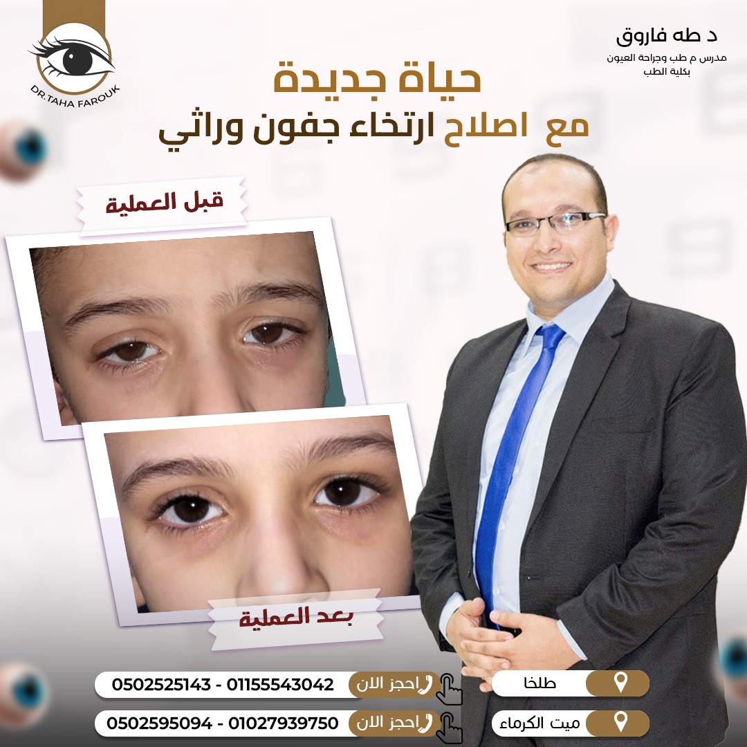 عمليات إصلاح ارتخاء الجفون
