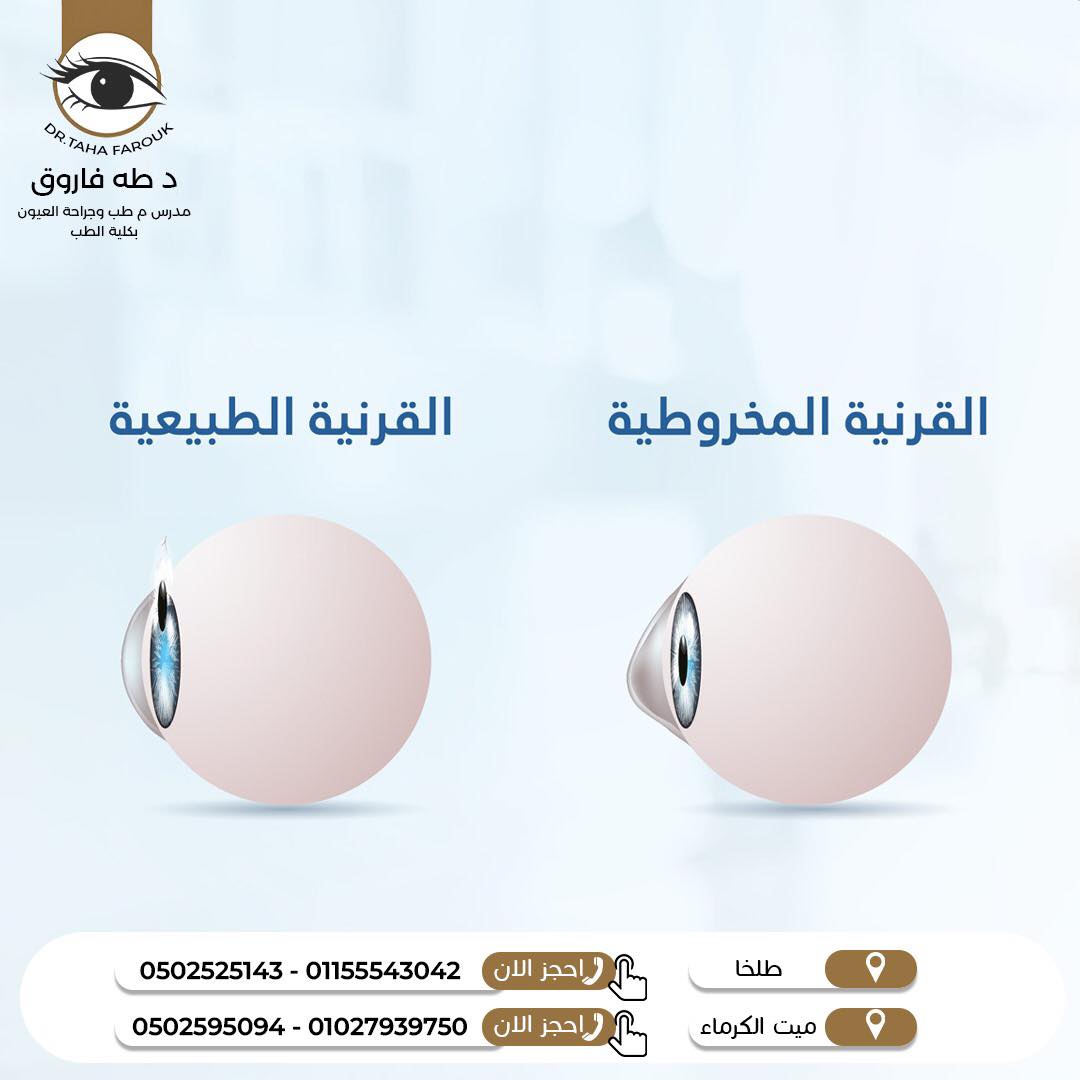 عمليات القرنية المخروطية | الأنواع والخطوات مع د. طه فاروق